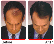 Toppik for men before and after using the product.