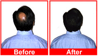 HairMagic effectively covers balding or thining area.